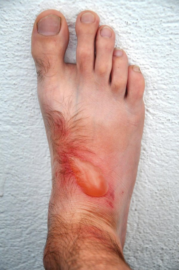 Cloque de sang : quand consulter votre médecin ?